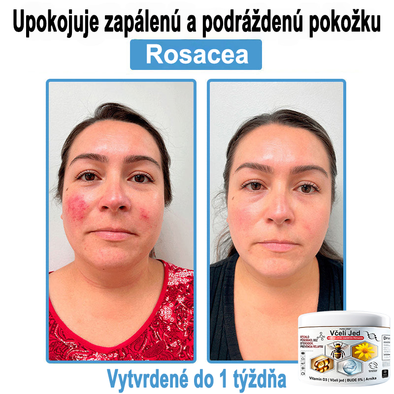 🔥 Dnes až -70% Purelora®⭐ Bee Venom Multi-Symptom Skin Treatment Cream (👨‍⚕𝑶𝒅𝒑𝒐𝒓ú𝒄𝒂 𝑵𝑷𝑭)⚡
