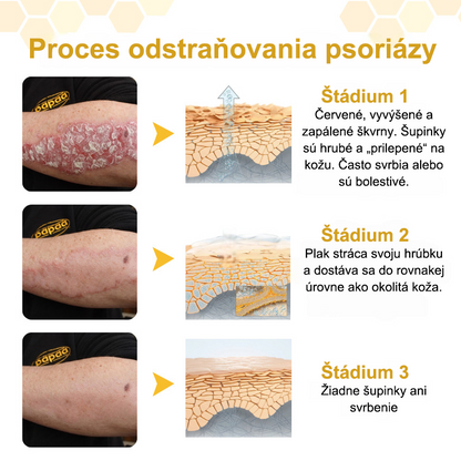 Dnes až so zľavou 70 %! 🔥 Purelora® PsoriaSoothe regeneračný krém s včelím jedom pre starostlivosť o pokožku
