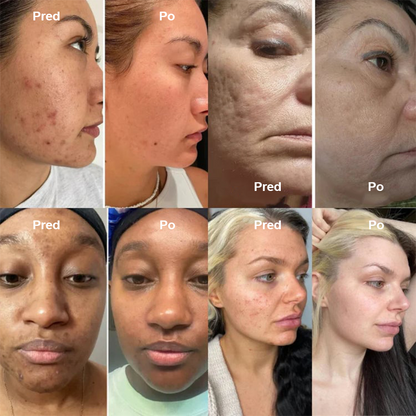 🍀 Purelora® Instantný krém na lifting krku — 🎁 Obohatený o retinol a kyselinu hyalurónovú | Pomáha spevniť pokožku krku, redukovať vrásky a zlepšiť vzhľad dvojitej brady