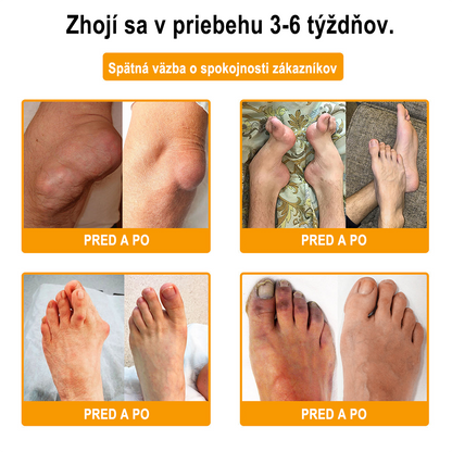 🇸🇰Purelora® krém na hojenie kostí s botulotoxínom🐝a včelím jedom, ktorý zmierňuje bolesť🌿 (špeciálne pre starších ľudí a odporúčaný ortopedickými špecialistami)🔥