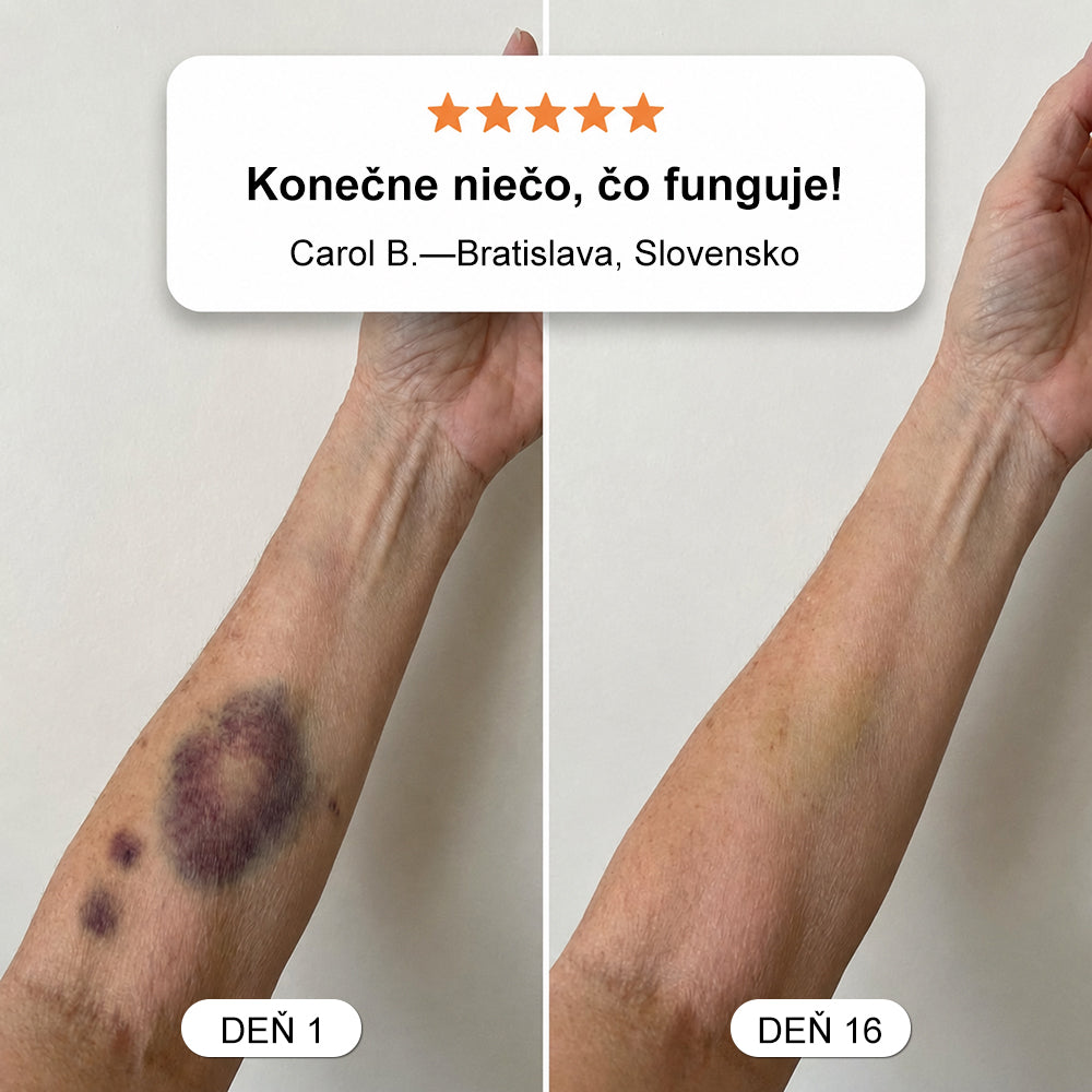 💥Vyše 100 000 PREDANÝCH💕- Purelora® krém na opravu modrín a posilnenie pokožky