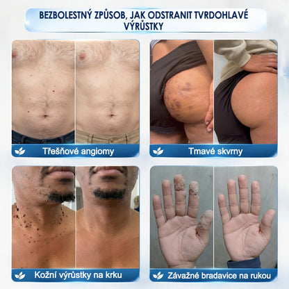 Oficiálny obchod značky |🔥Purelora® 7-dňový odstraňovač kožných výrastkov a škvŕn (bez bolesti, bez jaziev – rollerball aplikátor)🌈