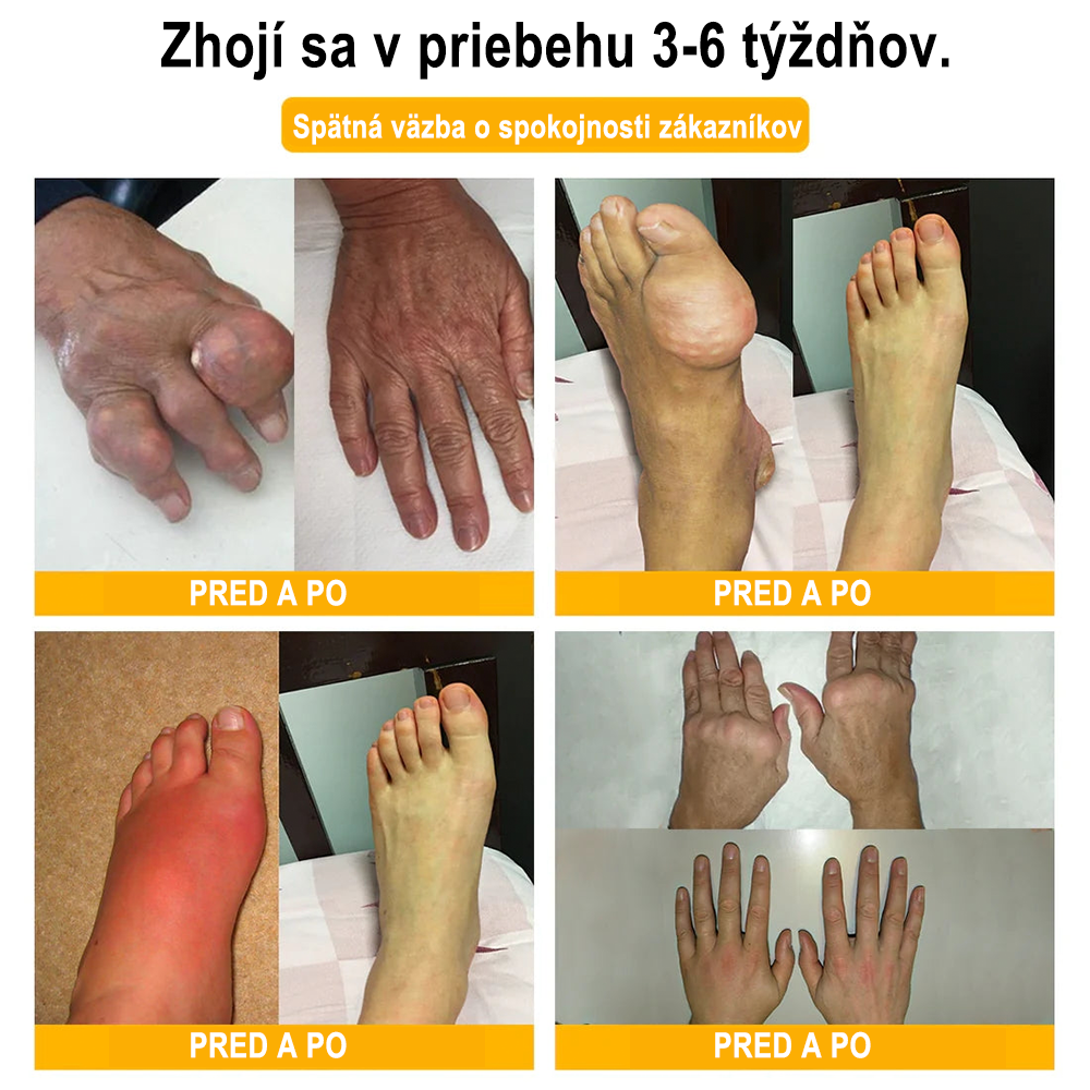 🇸🇰Purelora® krém na hojenie kostí s botulotoxínom🐝a včelím jedom, ktorý zmierňuje bolesť🌿 (špeciálne pre starších ľudí a odporúčaný ortopedickými špecialistami)🔥