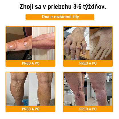 🇸🇰Purelora® krém na hojenie kostí s botulotoxínom🐝a včelím jedom, ktorý zmierňuje bolesť🌿 (špeciálne pre starších ľudí a odporúčaný ortopedickými špecialistami)🔥